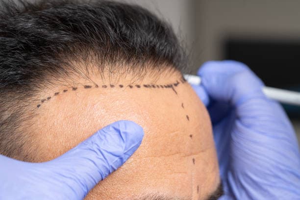 Hair Transplant Turkey Cost Breakdown: Grafts, Techniques, and Care