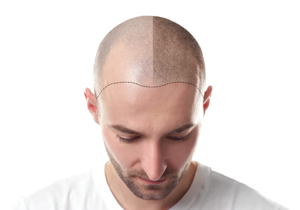 Experience Excellence in Hair Transplant London with Westminster Medical Group®