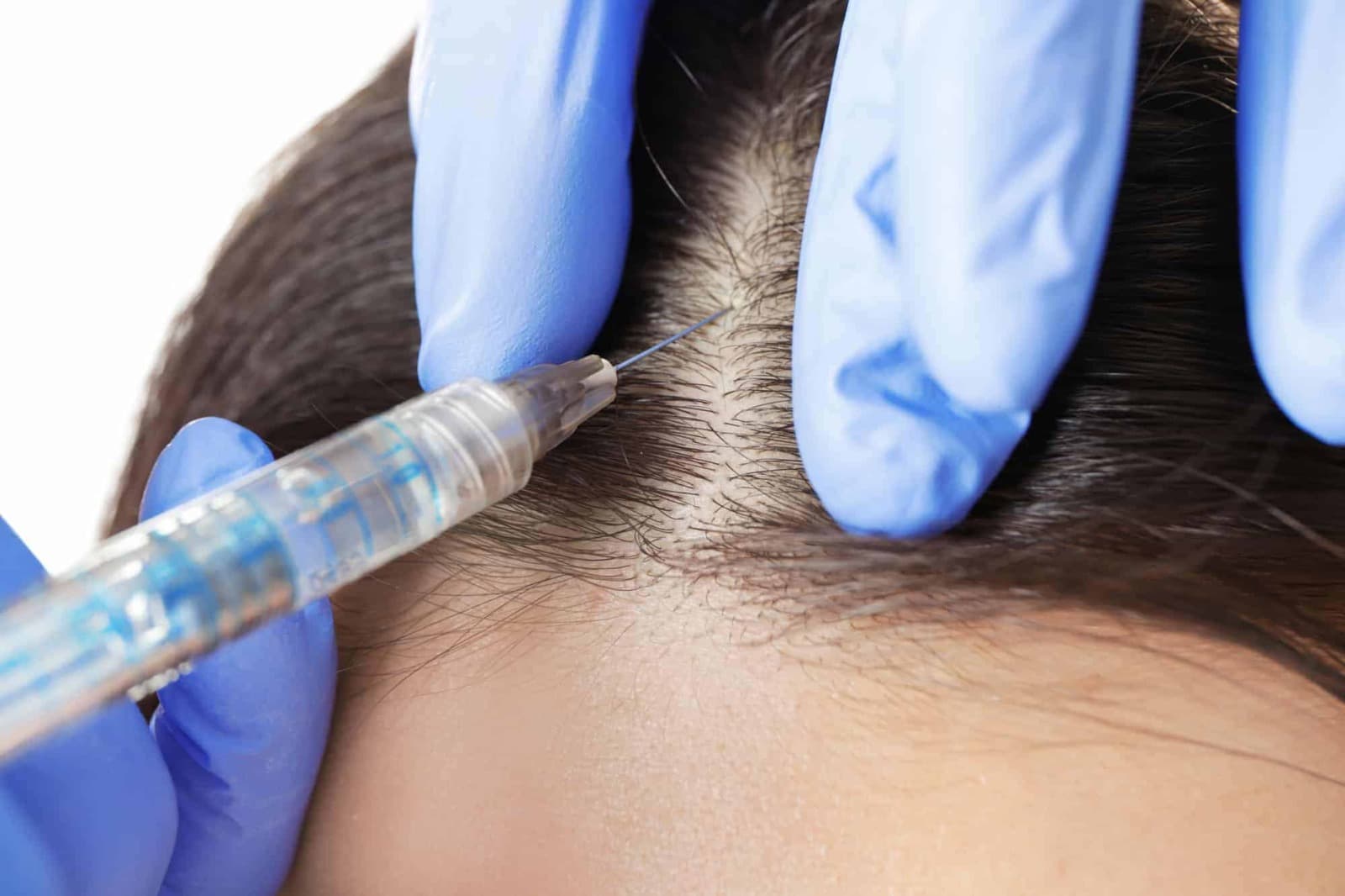 Hair Transplant Turkey: How to Achieve a Permanent Solution
