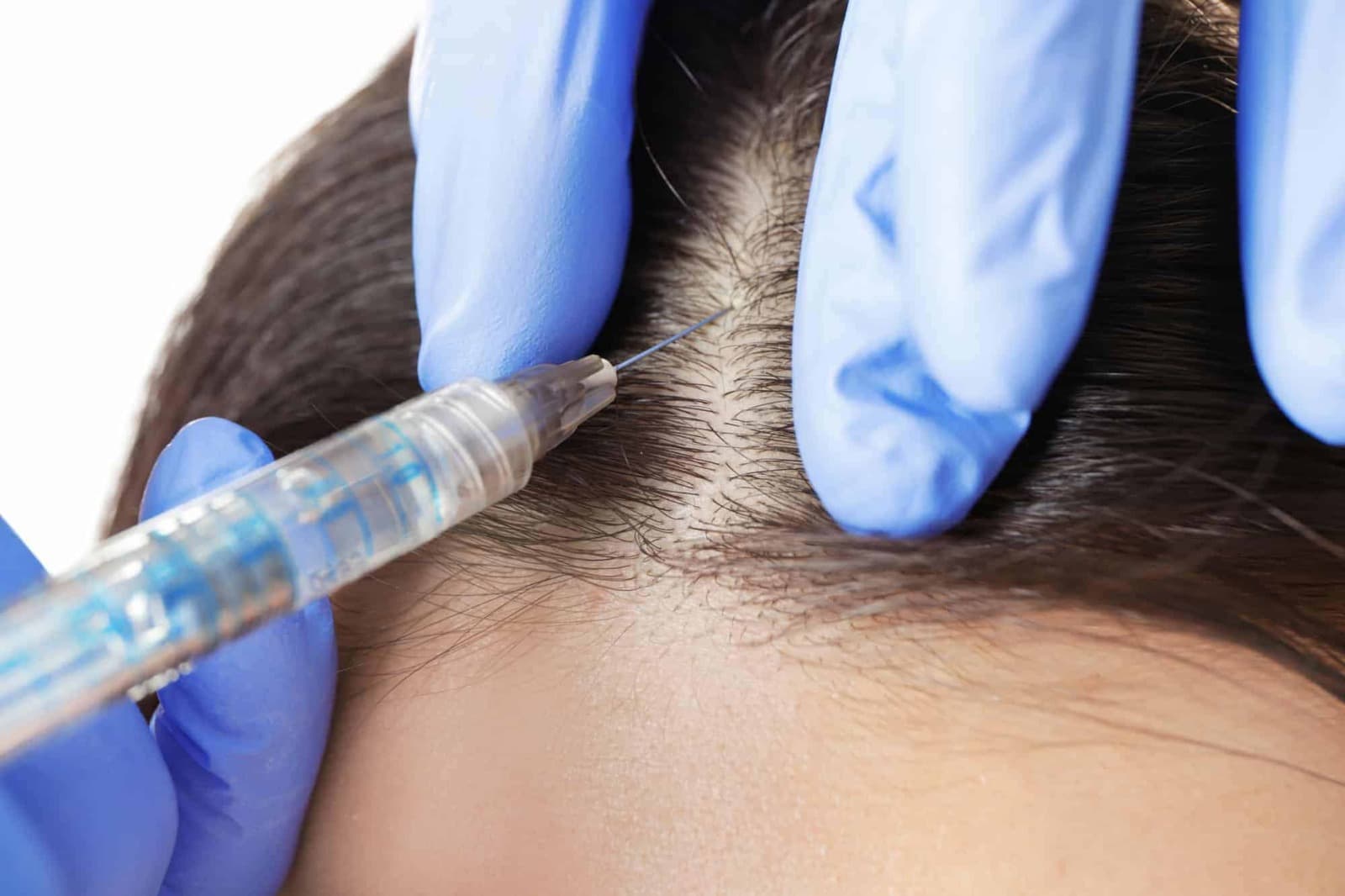 Affordable Hair Transplant Istanbul at Sapphire Hair Clinic