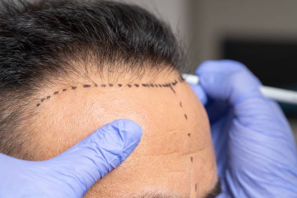 Hair Transplant Turkey Cost Breakdown: Grafts, Techniques, and Care